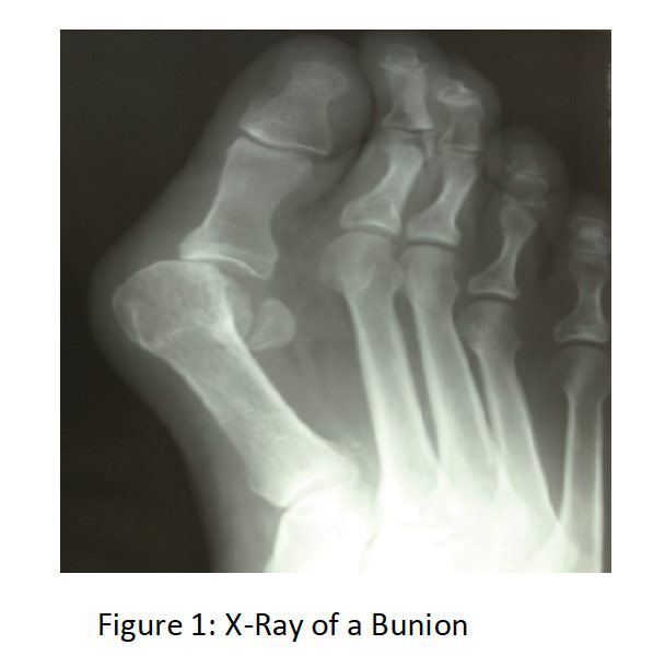 Bunion Causes & Treatment DLT Podiatry
