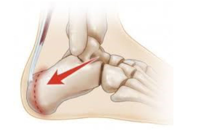 Severs Pain Pattern Severs Condition | DLT Podiatry