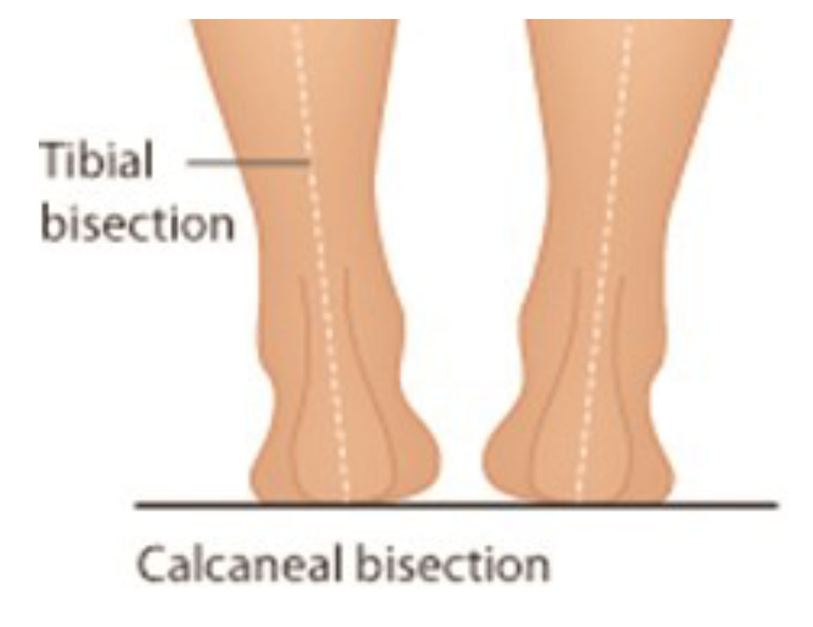 Medial Knee Pain Causes and Treatments DLT Podiatry